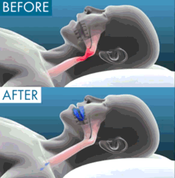 NattSkena - För dig som vill sova, inte snarka