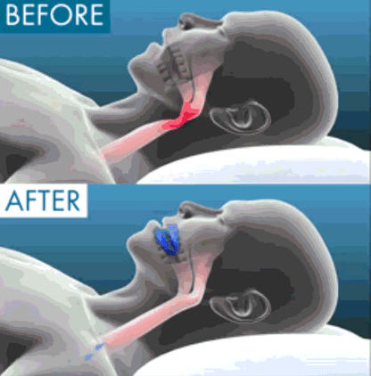 NattSkena - För dig som vill sova, inte snarka